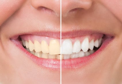 Blanchiment-des-dents-Dentistes-Shawinigan