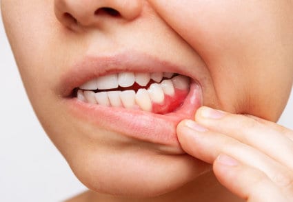 Parodontie-Dentistes-Shawinigan-Ac