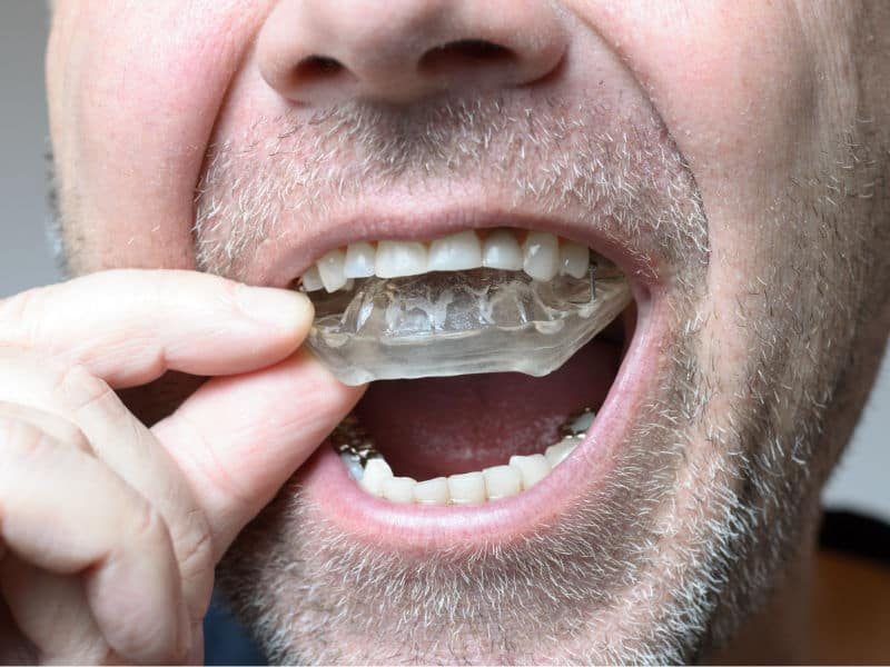 la plaque occlusale dentistes shawinigan