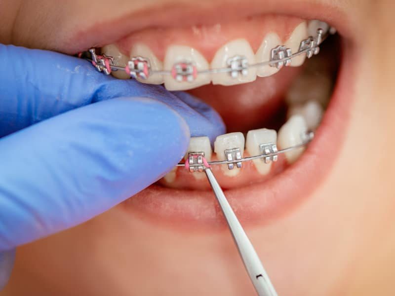 Orthodontie-Fixe-Dentistes-Shawinigan