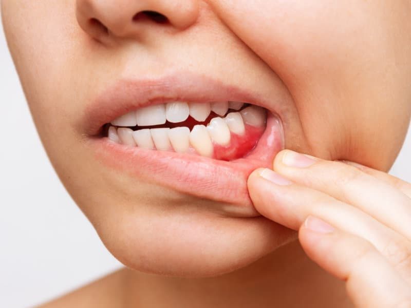 Parodontie-Dentistes-Shawinigan